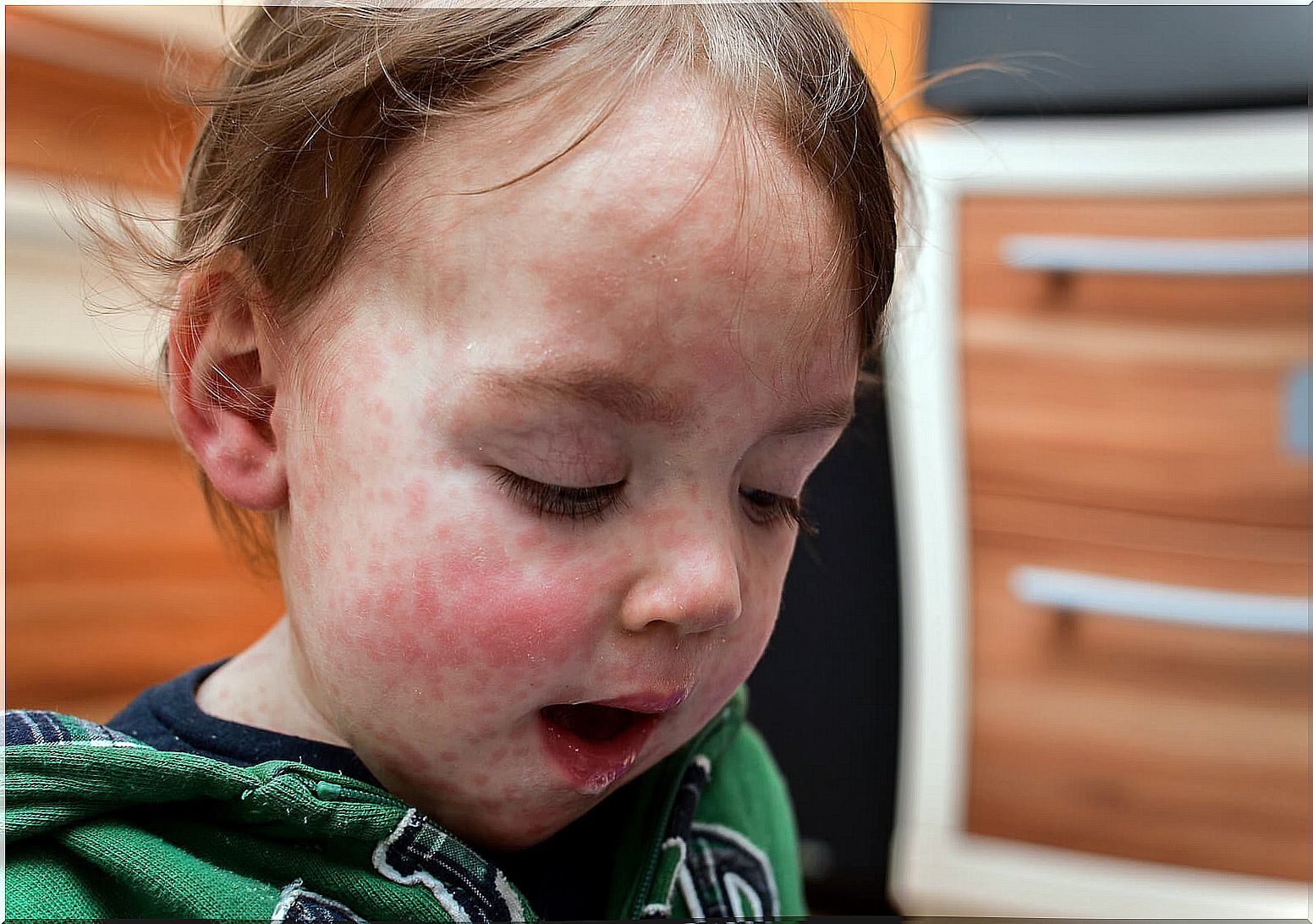 Child with a face full of welts because he suffers from an allergy to cow's milk protein.