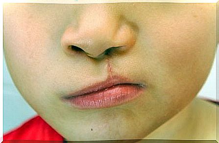 Cleft lip: what is it and what are its consequences