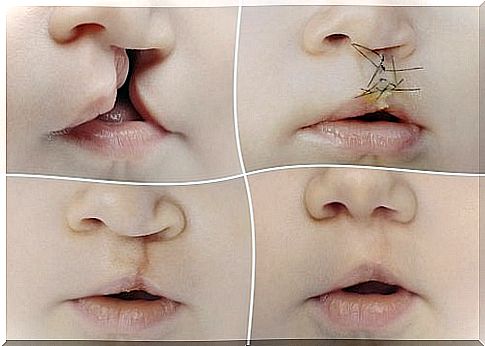 Cleft lip can be corrected through surgery.