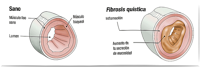 Cystic fibrosis