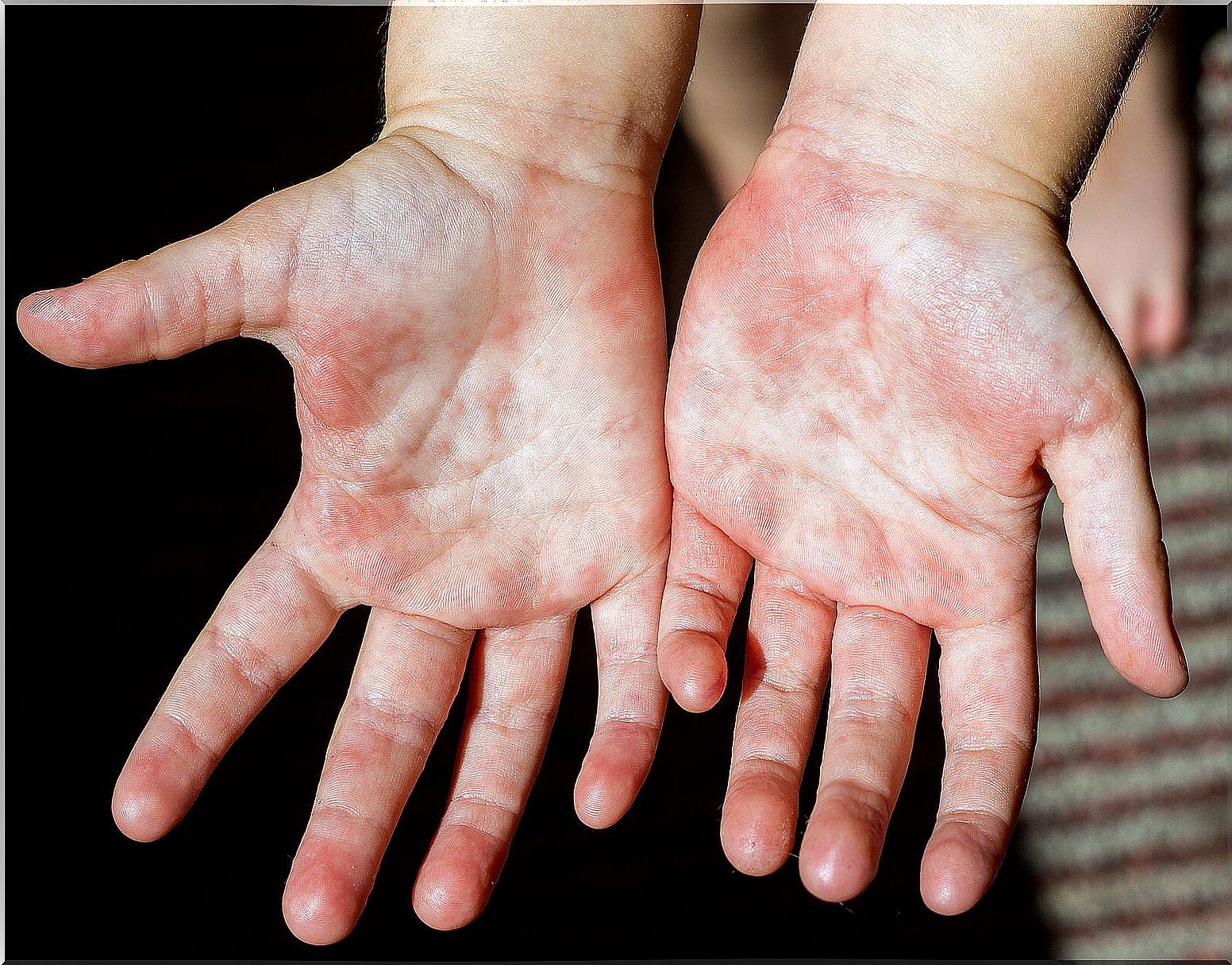 Pyodermatitis in children