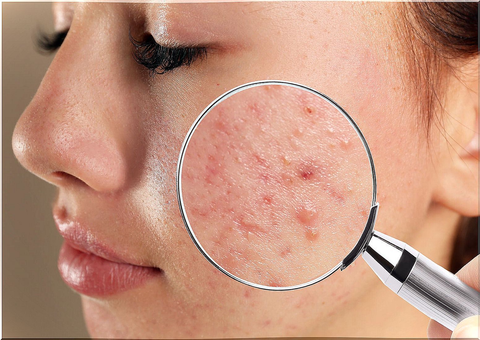 Juvenile acne: types and causes