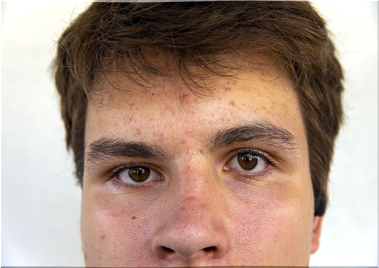 Teen boy with juvenile acne.