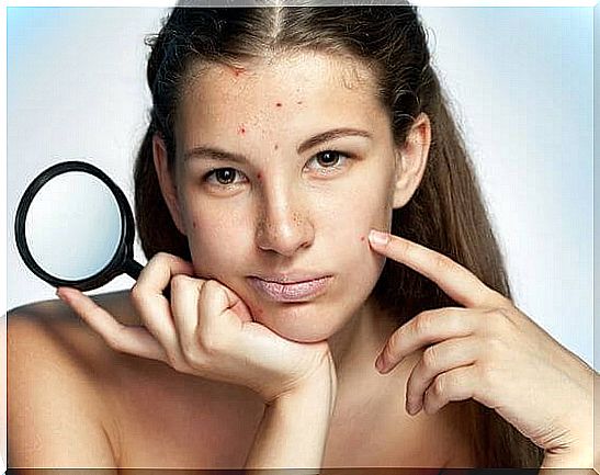 Solutions for your teenager's acne