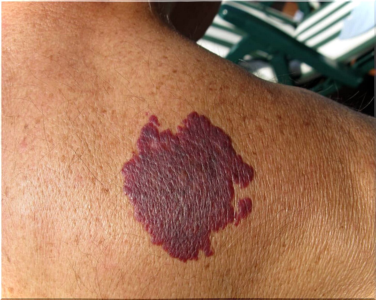 Purple spot on the skin.