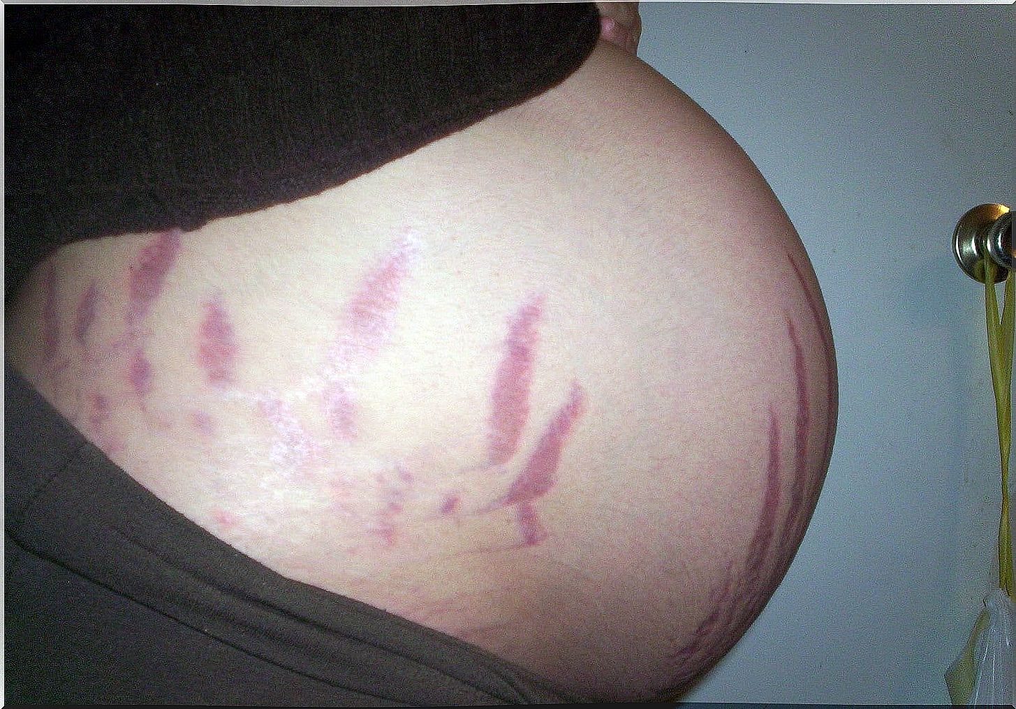 Why do stretch marks appear during pregnancy