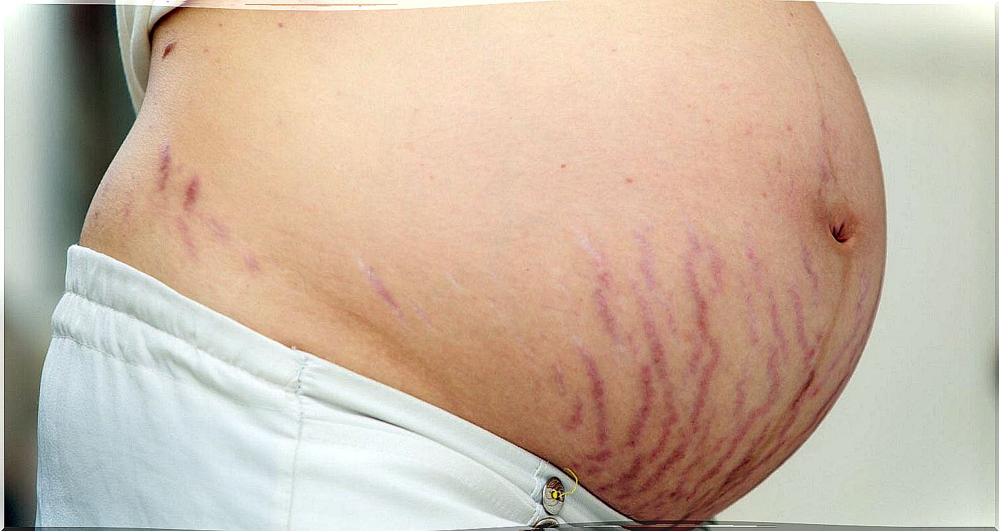 stretch marks 2