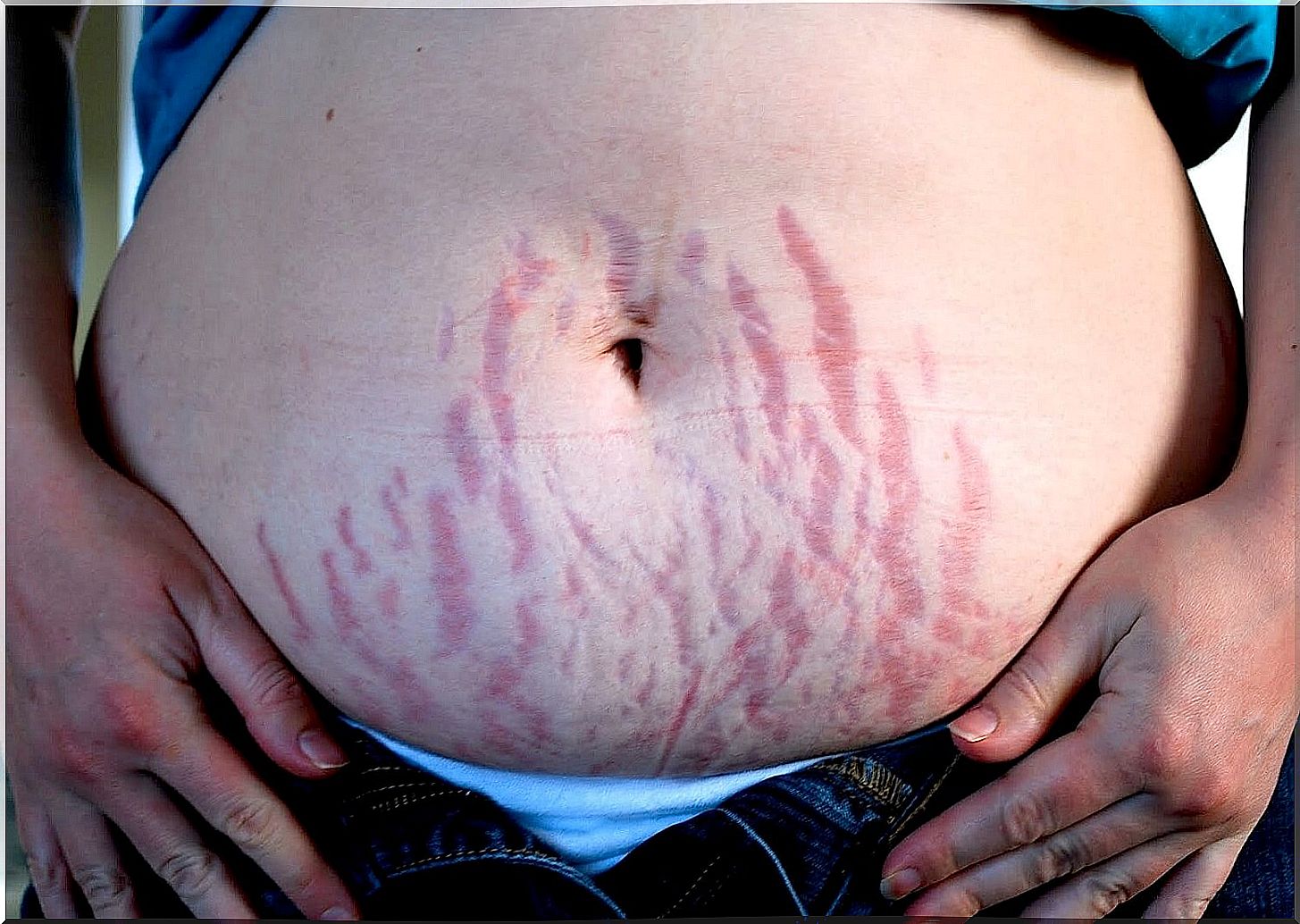 stretch marks 